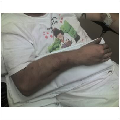 brokenarm.jpg