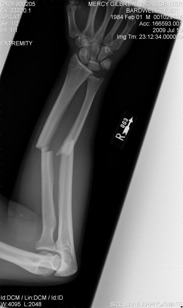 Tylersx-raysbrokenarm2.jpg